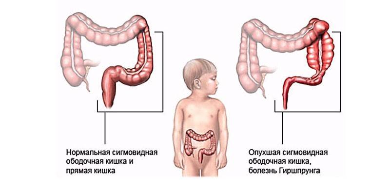 Долихосигма кишечника у дитини - перші ознаки, особливості терапії, масаж і дієта