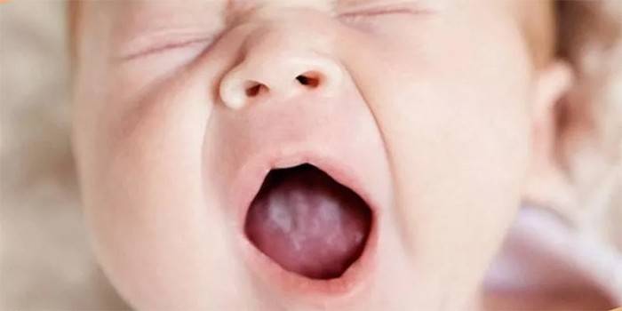 Білий наліт у роті у дитини - чому з'являється, як лікувати медикаментами і народними засобами