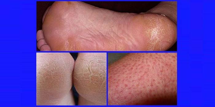 Гіперкератоз шкіри і нігтів - ознаки потовщення і ороговіння, засоби лікування