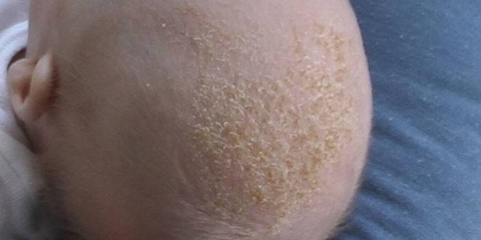 Себорейні скоринки на голові у малюка: чим прибрати дерматит у дитини