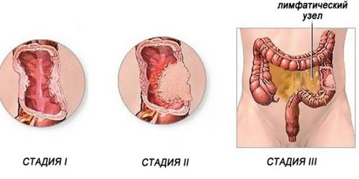Рак прямої кишки - перші симптоми і ознаки