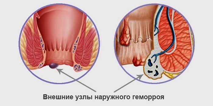 Тромбоз гемороїдального вузла: як лікувати захворювання в домашніх умовах
