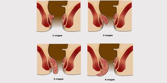 Симптоми геморою у чоловіків: перші ознаки внутрішнього і зовнішнього