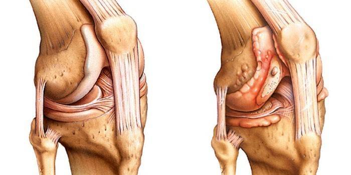 Артрит колінного суглоба - симптоми і лікування в домашніх умовах