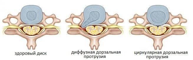 Протрузія дисків шийного відділу хребта: симптоми і лікування