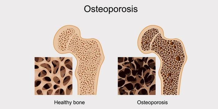 Як лікувати остеопороз суглобів і кісток у жінок в домашніх умовах