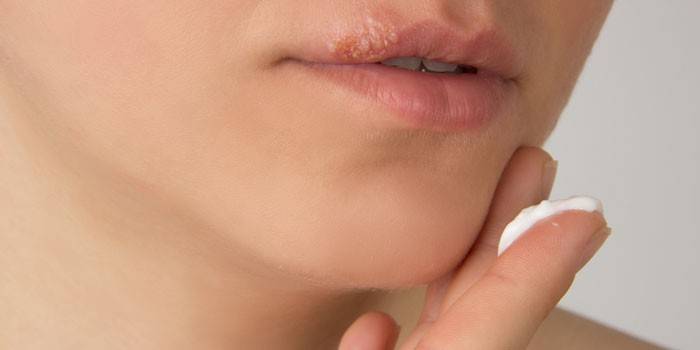 Болячка на губі - симптоми і різновиди захворювання: як лікувати виразку, засоби, щоб позбутися ранки