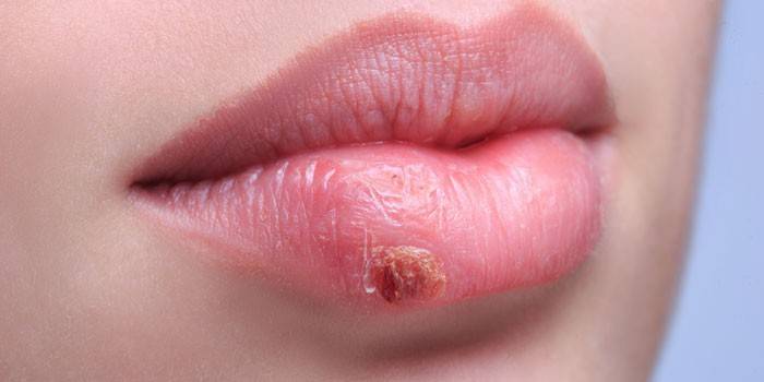 Червоний плоский лишай в порожнині рота - симптоми, лікування препаратами і народними засобами