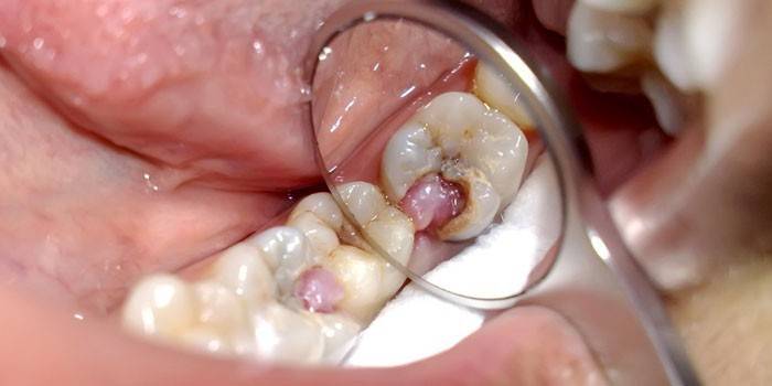 Пульпіт зуба - що це таке, симптоми захворювання і лікування у дитини або дорослого