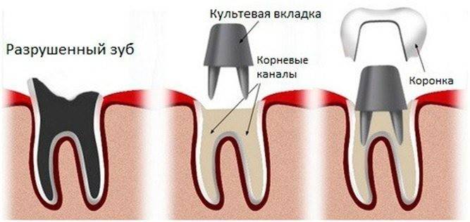 Вкладка в зуб під коронку - вартість протезування кореневих каналів, фіксація штифта докорінно