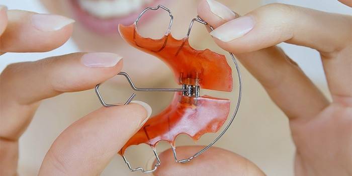 Пластини для вирівнювання зубів у дітей без брекетів