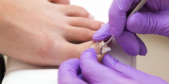 Видалення нігтя на нозі і на руці: причини, методи і засоби для зняття нігтьової пластини, лікування після резекції