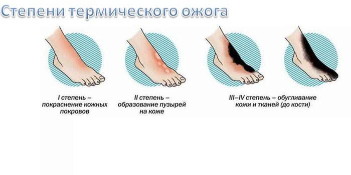 Перша допомога при опіках в домашніх умовах за ступенем поразок