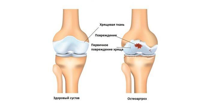 Остеоартроз колінного суглоба - причини, засоби та методи терапії
