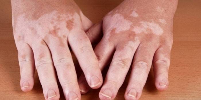 Хвороба Аддісона - ознаки виникнення, прояви на шкірі і замісна гормональна терапія