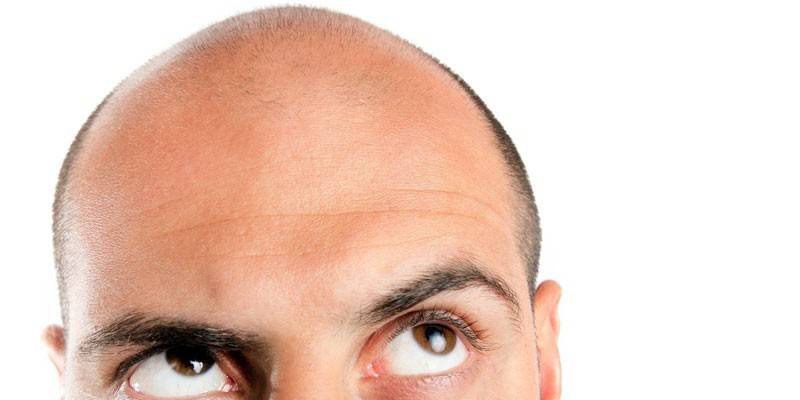 Дифузне випадання волосся - симптоми і типи, методи терапії і корекції