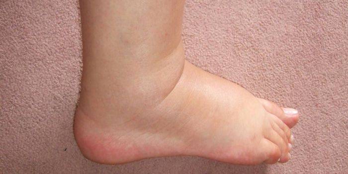 Чому набрякають ноги в щиколотках у жінок: причини набрякання кінцівок у жінок