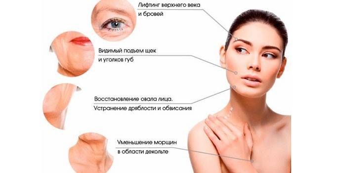 Векторний ліфтинг обличчя - протипоказання, догляд за шкірою після корекції