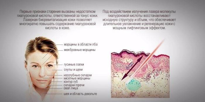 Лазерна біоревіталізація - опис методики омолодження шкіри, етапи проведення та результати