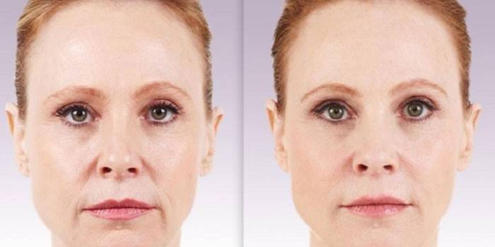 Контурна пластика обличчя з фото до і після, відгуками і цінами, препарати для процедури
