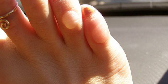 Як позбутися мозолів на пальцях ніг і запобігти утворенню натоптишів
