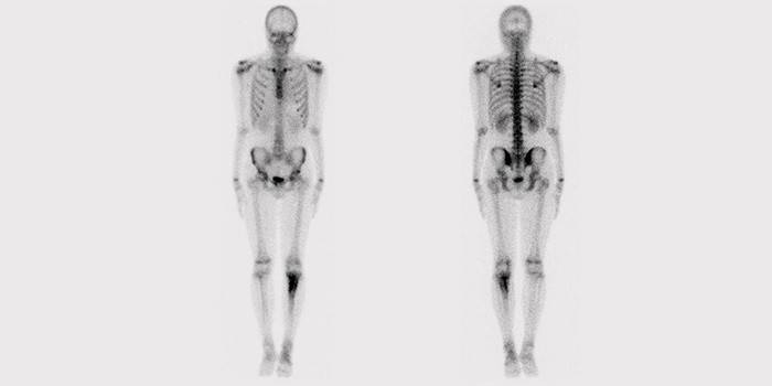 Сцинтиграфія кісток скелета: підготовка, проведення та обстеження ціна