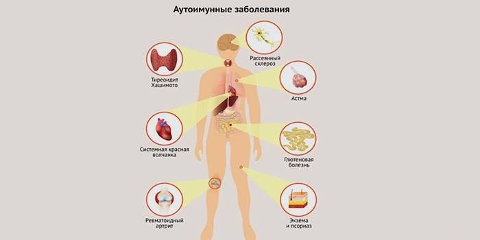 Аутоімунні захворювання щитовидної залози: список причин і способи лікування