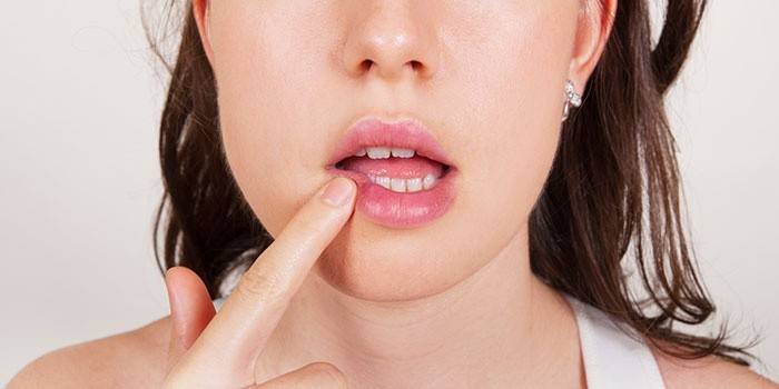 Чим лікувати куточки губ швидко: як прибрати заїди, тріщини і болячки